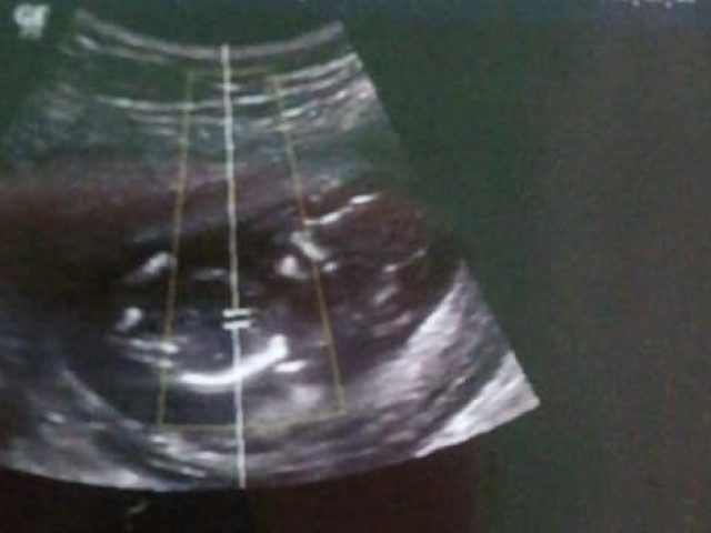 Grávida de Não-Me-Toque descobre que bebê está morto há duas semanas e aguarda por procedimento para retirada do feto