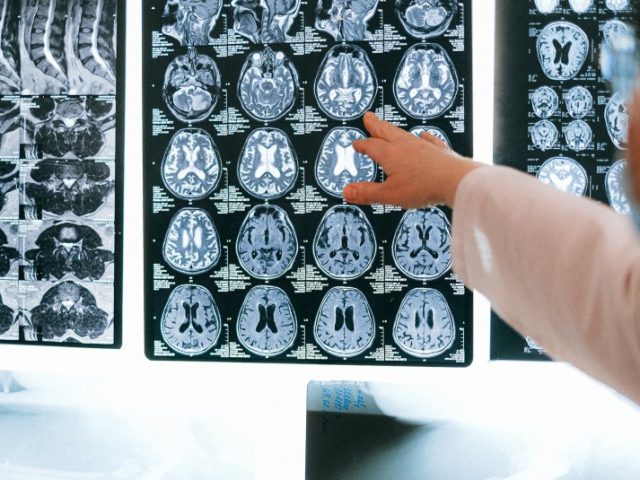Covid-19 provoca alterações no cérebro, mesmo em casos leves, diz estudo